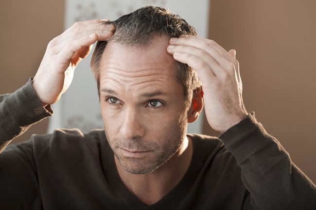 7 Male Hair Loss Causes 
