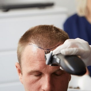 What to Know About the Micro FUE Hair Transplant Procedure