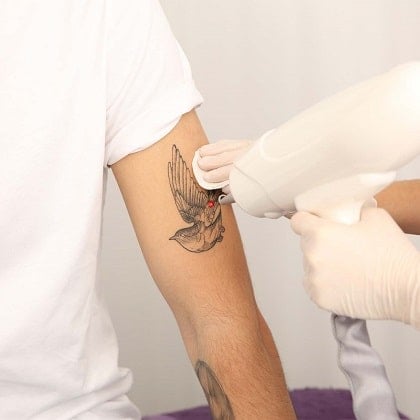 Boost Your Body Confidence by Removing Embarrassing Tattoos