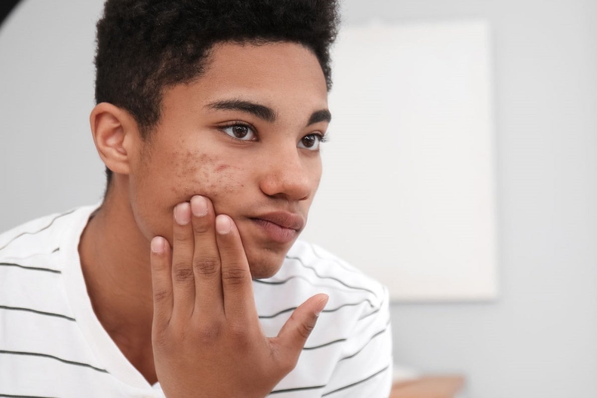 Teen Acne and Epiduo Gel: What You Need to Know