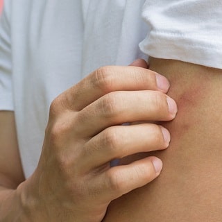 3 Natural Remedies for Eczema
