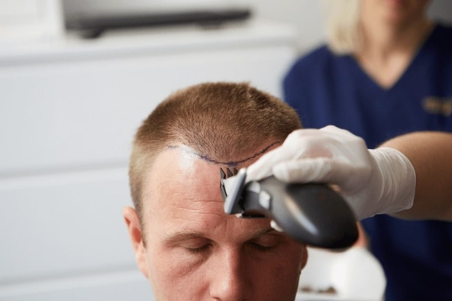 What to Know About the Micro FUE Hair Transplant Procedure