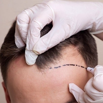Easy Ways to Find Good Hair Transplant Services