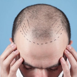 Which Country is Best for Hair Transplants?